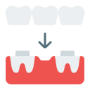 puente dental 