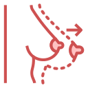 Breast augmentation 