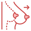Breast augmentation 