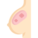câncer de mama 